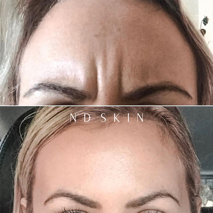 Anti-wrinkle Before and After