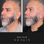 Before and After mens filler