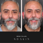 Before and After mens filler