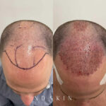 Before and After NeoGraft