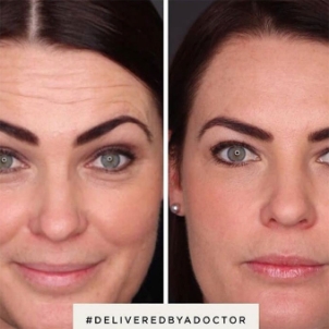 Anti Wrinkle Injections - Before and after Botox injections by ND Skin