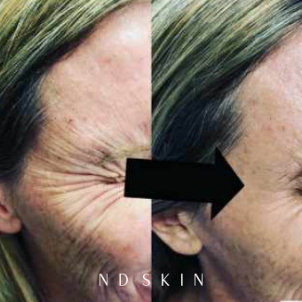 Anti Wrinkle Injections - Before and after Botox wrinkle relaxing injections by Dr Nik Davies