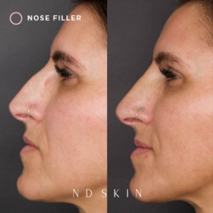 Dermal fillers before and after 01, ND Skin