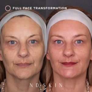 Dermal fillers B&A 02, full face transformation