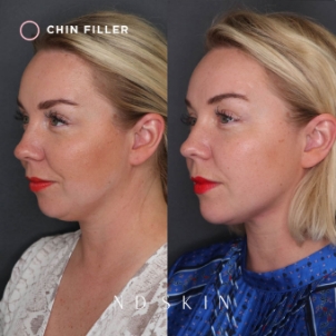 ND Skin, dermal fillers before and after 03