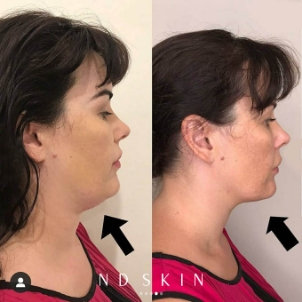Fat dissolving injections, before and after 02, ND Skin