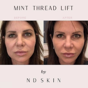 Mint thread lift, Before and after, Central Coast, Newcastle, Sydney