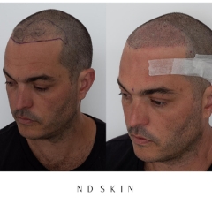 Hair transplant before and after 01, ND Skin