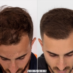 Neograft Hair Restoration Newcastle by Dr Nik Davies of ND Skin