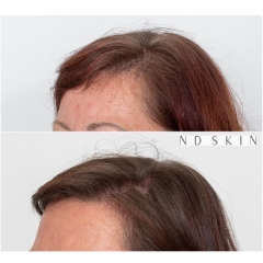 Neograft Hair Restoration Central Coast by Dr Nik Davies of ND Skin