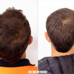 Neograft Hair Restoration Sydney by Dr Nik Davies of ND Skin
