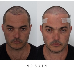 Neograft Hair Restoration, hair loss treatment by Dr Nik Davies of ND Skin Sydney, Central Coast, Newcastle