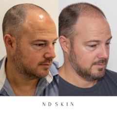 Neograft Hair Restoration, hair transplant by Dr Nik Davies of ND Skin Sydney, Central Coast, Newcastle