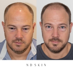 Neograft Hair Restoration, hair transplant Sydney by Dr Nik Davies of ND Skin