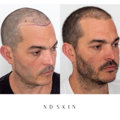 Neograft Hair Restoration, hair transplant Central Coast by Dr Nik Davies of ND Skin