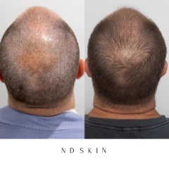 Neograft Hair Restoration, hair transplant Newcastle by Dr Nik Davies of ND Skin