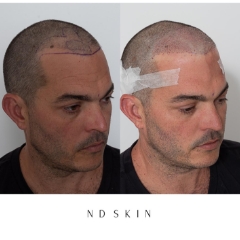Neograft Hair Restoration, hair replacement Sydney by Dr Nik Davies of ND Skin