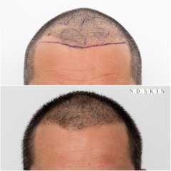 Neograft Hair Restoration, hair replacement Central Coast by Dr Nik Davies of ND Skin