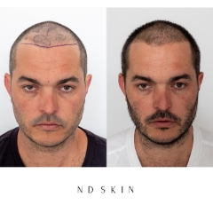 Neograft Hair Restoration, hair replacement Newcastle by Dr Nik Davies of ND Skin