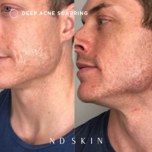 PRP for acne scarring, before and after 01