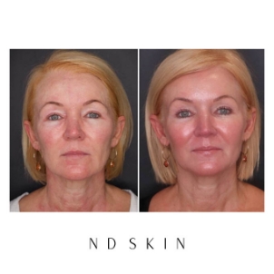 Short PDO threads treatment by Dr Nik Davies of ND Skin Sydney, before and after