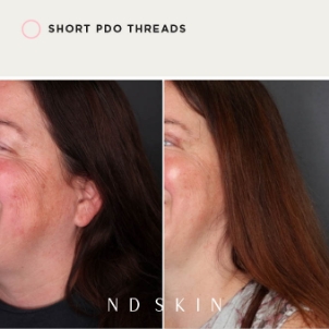 Short PDO threads treatment by Dr Nik Davies of ND Skin Central Coast, before and after