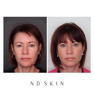 Short PDO threads treatment by Dr Nik Davies of ND Skin Newcastle, before and after